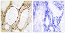IRF2 Antibody - Immunohistochemistry analysis of paraffin-embedded human colon carcinoma tissue, using IRF2 Antibody. The picture on the right is blocked with the synthesized peptide.