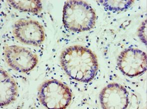 IRF2 Antibody - Immunohistochemistry of paraffin-embedded human rectal cancer using antibody at 1:100 dilution.