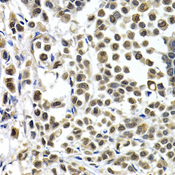 IRF2 Antibody - Immunohistochemistry of paraffin-embedded human breast cancer tissue.