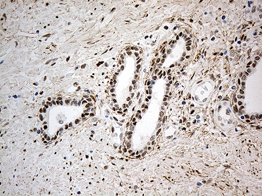 IRF2BP1 Antibody - Immunohistochemical staining of paraffin-embedded Carcinoma of Human prostate tissue using anti-IRF2BP1 mouse monoclonal antibody. (Heat-induced epitope retrieval by 1mM EDTA in 10mM Tris buffer. (pH8.5) at 120°C for 3 min. (1:500)
