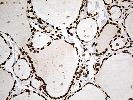 IRF2BP1 Antibody - Immunohistochemical staining of paraffin-embedded Human thyroid tissue within the normal limits using anti-IRF2BP1 mouse monoclonal antibody. (Heat-induced epitope retrieval by 1mM EDTA in 10mM Tris buffer. (pH8.5) at 120°C for 3 min. (1:500)