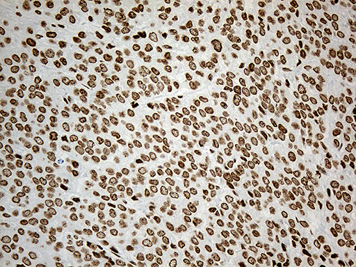 IRF2BP1 Antibody - Immunohistochemical staining of paraffin-embedded Adenocarcinoma of Human breast tissue tissue using anti-IRF2BP1 mouse monoclonal antibody. (Heat-induced epitope retrieval by 1mM EDTA in 10mM Tris buffer. (pH8.5) at 120°C for 3 min. (1:500)