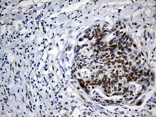 IRF2BP1 Antibody - Immunohistochemical staining of paraffin-embedded Adenocarcinoma of Human endometrium tissue using anti-IRF2BP1 mouse monoclonal antibody. (Heat-induced epitope retrieval by 1mM EDTA in 10mM Tris buffer. (pH8.5) at 120°C for 3 min. (1:250)