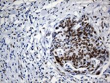 IRF2BP1 Antibody - Immunohistochemical staining of paraffin-embedded Adenocarcinoma of Human endometrium tissue using anti-IRF2BP1 mouse monoclonal antibody. (Heat-induced epitope retrieval by 1mM EDTA in 10mM Tris buffer. (pH8.5) at 120°C for 3 min. (1:250)