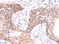 IRF2BP1 Antibody - Immunohistochemistry of paraffin-embedded Human esophagus cancer tissue  using IRF2BP1 Polyclonal Antibody at dilution of 1:40(×200)