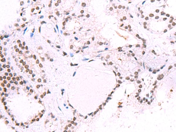 IRF2BP1 Antibody - Immunohistochemistry of paraffin-embedded Human thyroid cancer tissue  using IRF2BP1 Polyclonal Antibody at dilution of 1:40(×200)