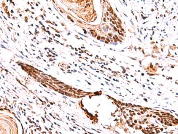 IRF2BP1 Antibody - Immunohistochemistry of paraffin-embedded Human esophagus cancer tissue  using IRF2BP1 Polyclonal Antibody at dilution of 1:30(×200)