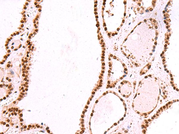 IRF2BP1 Antibody - Immunohistochemistry of paraffin-embedded Human thyroid cancer tissue  using IRF2BP1 Polyclonal Antibody at dilution of 1:30(×200)