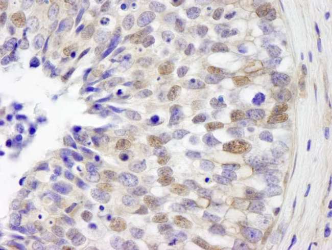 IRF3 Antibody - Detection of Human IRF3 by Immunohistochemistry. Sample: FFPE section of human breast adenocarcinoma. Antibody: Affinity purified rabbit anti-IRF3 used at a dilution of 1:250.