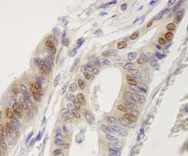 IRF3 Antibody - Detection of Human IRF3 by Immunohistochemistry. Sample: FFPE section of human colon adenocarcinoma. Antibody: Affinity purified rabbit anti-IRF3 used at a dilution of 1:250.
