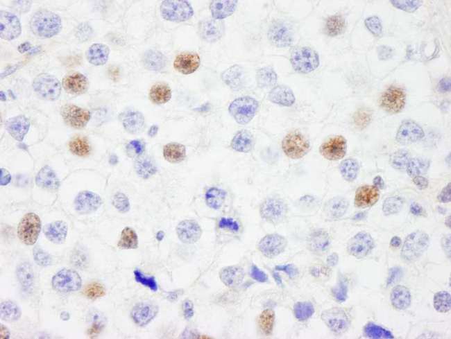 IRF3 Antibody - Detection of Human IRF3 by Immunohistochemistry. Sample: FFPE section of human testicular seminoma. Antibody: Affinity purified rabbit anti-IRF3 used at a dilution of 1:1000 (1 Detection: DAB.