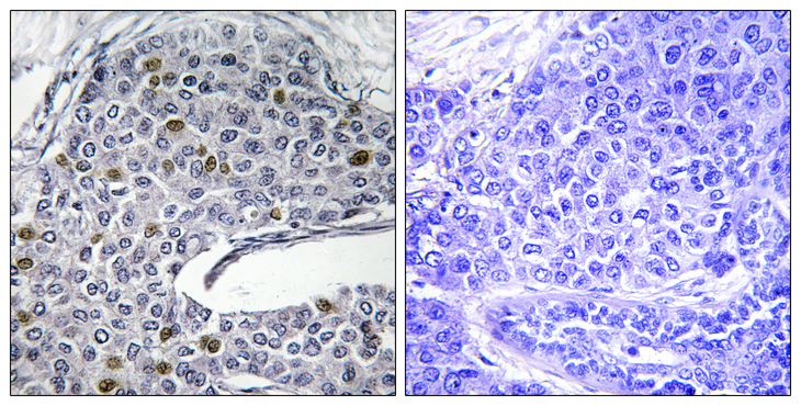 IRF3 Antibody - Immunohistochemistry analysis of paraffin-embedded human lung carcinoma tissue, using IRF3 Antibody. The picture on the right is blocked with the synthesized peptide.