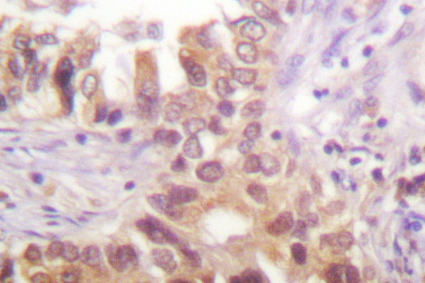 IRF3 Antibody - IHC of IRF-3 (A379) pAb in paraffin-embedded human lung carcinoma tissue.
