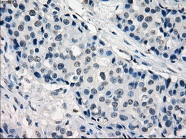 IRF3 Antibody - IHC of paraffin-embedded Adenocarcinoma of breast tissue using anti-IRF3 mouse monoclonal antibody. (Dilution 1:50).