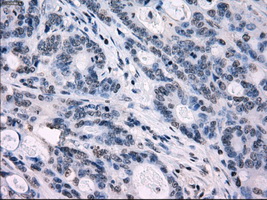 IRF3 Antibody - IHC of paraffin-embedded Adenocarcinoma of colon tissue using anti-IRF3 mouse monoclonal antibody. (Dilution 1:50).
