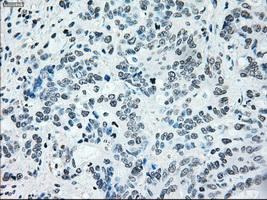 IRF3 Antibody - Immunohistochemical staining of paraffin-embedded Adenocarcinoma of colon tissue using anti-IRF3 mouse monoclonal antibody. (Dilution 1:50).