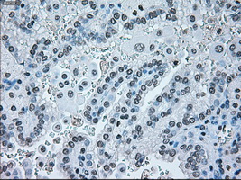 IRF3 Antibody - Immunohistochemical staining of paraffin-embedded Carcinoma of kidney tissue using anti-IRF3 mouse monoclonal antibody. (Dilution 1:50).
