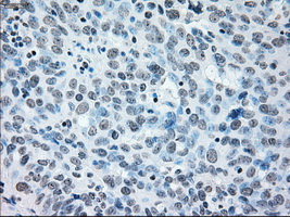 IRF3 Antibody - Immunohistochemical staining of paraffin-embedded Adenocarcinoma of ovary tissue using anti-IRF3 mouse monoclonal antibody. (Dilution 1:50).