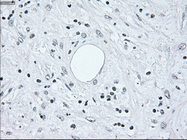IRF3 Antibody - Immunohistochemical staining of paraffin-embedded Carcinoma of pancreas tissue using anti-IRF3 mouse monoclonal antibody. (Dilution 1:50).