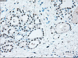 IRF3 Antibody - Immunohistochemical staining of paraffin-embedded thyroid tissue using anti-IRF3 mouse monoclonal antibody. (Dilution 1:50).