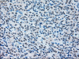 IRF3 Antibody - Immunohistochemical staining of paraffin-embedded Carcinoma of thyroid tissue using anti-IRF3 mouse monoclonal antibody. (Dilution 1:50).