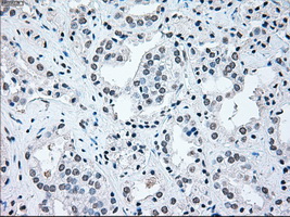 IRF3 Antibody - Immunohistochemical staining of paraffin-embedded Carcinoma of prostate tissue using anti-IRF3 mouse monoclonal antibody. (Dilution 1:50).
