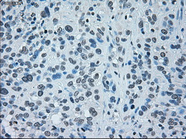 IRF3 Antibody - Immunohistochemical staining of paraffin-embedded Carcinoma of bladder tissue using anti-IRF3 mouse monoclonal antibody. (Dilution 1:50).