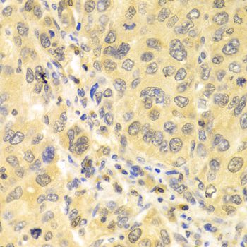 IRF3 Antibody - Immunohistochemistry of paraffin-embedded human liver cancer using IRF3 antibody at dilution of 1:100 (40x lens).
