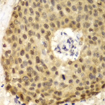 IRF3 Antibody - Immunohistochemistry of paraffin-embedded human lung cancer using IRF3 antibody at dilution of 1:100 (40x lens).