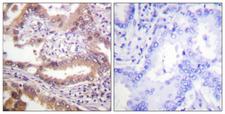 IRF3 Antibody - Peptide - + Immunohistochemistry analysis of paraffin-embedded human lung carcinoma tissue using IRF-3 (Ab-385) antibody.