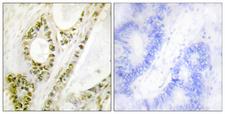 IRF3 Antibody - Immunohistochemistry analysis of paraffin-embedded human colon carcinoma, using IRF-3 (Phospho-Ser385) Antibody. The picture on the right is blocked with the phospho peptide.