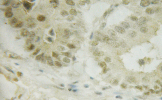 IRF3 Antibody - 1/100 staining human lung tissue by IHC-P. The sample was formaldehyde fixed and a heat mediated antigen retrieval step in citrate buffer was performed. The sample was then blocked and incubated with the antibody for 1.5 hours at 22°C. An HRP conjugated goat anti-rabbit antibody was used as the secondary antibody.