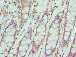 IRF4 Antibody - Immunohistochemistry of paraffin-embedded human rectal cancer using antibody at 1:100 dilution.