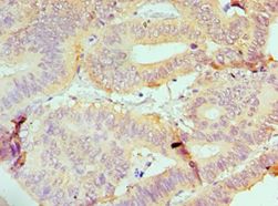 IRF4 Antibody - Immunohistochemistry of paraffin-embedded human colon cancer using antibody at 1:100 dilution.