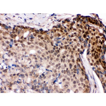 IRF5 Antibody - IRF5 antibody IHC-paraffin. IHC(P): Human Mammary Cancer Tissue.
