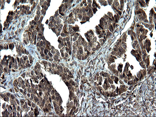 IRF5 Antibody - IHC of paraffin-embedded Adenocarcinoma of Human ovary tissue using anti-IRF5 mouse monoclonal antibody. (Heat-induced epitope retrieval by 1 mM EDTA in 10mM Tris, pH8.5, 120°C for 3min).