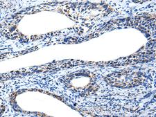 IRF5 Antibody - Immunohistochemistry of paraffin-embedded Human cervical cancer tissue  using IRF5 Polyclonal Antibody at dilution of 1:25(×200)