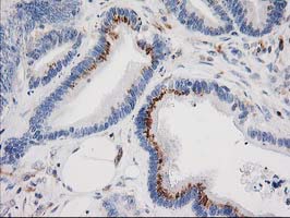 IRF6 Antibody - IHC of paraffin-embedded Adenocarcinoma of Human colon tissue using anti-IRF6 mouse monoclonal antibody.