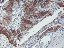 IRF6 Antibody - IHC of paraffin-embedded Carcinoma of Human lung tissue using anti-IRF6 mouse monoclonal antibody.
