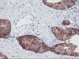IRF6 Antibody - IHC of paraffin-embedded Carcinoma of Human prostate tissue using anti-IRF6 mouse monoclonal antibody.