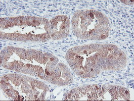 IRF6 Antibody - IHC of paraffin-embedded Adenocarcinoma of Human endometrium tissue using anti-IRF6 mouse monoclonal antibody.