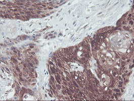 IRF6 Antibody - IHC of paraffin-embedded Carcinoma of Human bladder tissue using anti-IRF6 mouse monoclonal antibody.