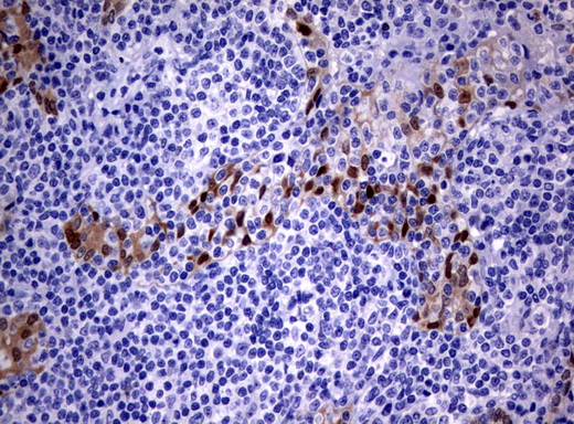IRF6 Antibody - Immunohistochemical staining of paraffin-embedded Human lymphoma tissue using anti-IRF6 mouse monoclonal antibody.  heat-induced epitope retrieval by 10mM citric buffer, pH6.0, 120C for 3min)