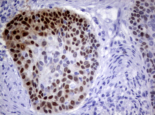 IRF6 Antibody - Immunohistochemical staining of paraffin-embedded Carcinoma of Human lung tissue using anti-IRF6 mouse monoclonal antibody.  heat-induced epitope retrieval by 10mM citric buffer, pH6.0, 120C for 3min)