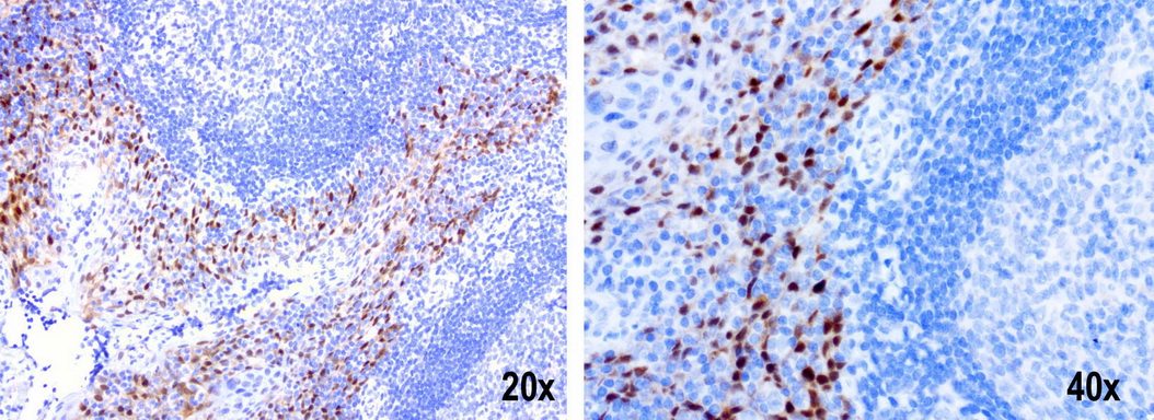 IRF6 Antibody - Immunohistochemical staining of paraffin-embedded human tonsil composit using anti-IRF6 clone UMAB106 mouse monoclonal antibody at 1:200 with Polink2 Broad HRP DAB detection kit ; heat-induced epitope retrieval with citrate buffer, pH6.0at 95-100C. Strong nuclear staining is seen in both the 20 and 40x however the 20x reveal the the squamous epithelial are positive for IRF6 and the cells of the germinal and non germinal centers are negative for IRF6.