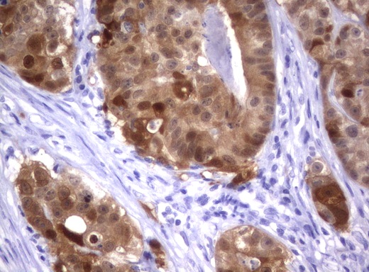 IRF6 Antibody - Immunohistochemical staining of paraffin-embedded Adenocarcinoma of Human colon tissue using anti-IRF6 mouse monoclonal antibody.  heat-induced epitope retrieval by 10mM citric buffer, pH6.0, 120C for 3min)