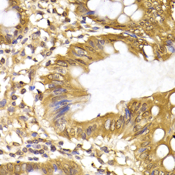 IRF6 Antibody - Immunohistochemistry of paraffin-embedded human colon cancer tissue.