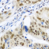 IRF6 Antibody - Immunohistochemical analysis of IRF-6 staining in human colon cancer formalin fixed paraffin embedded tissue section. The section was pre-treated using heat mediated antigen retrieval with sodium citrate buffer (pH 6.0). The section was then incubated with the antibody at room temperature and detected using an HRP conjugated compact polymer system. DAB was used as the chromogen. The section was then counterstained with hematoxylin and mounted with DPX.