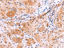 IRGC1 / CINEMA Antibody - Immunohistochemistry of paraffin-embedded Human liver cancer tissue  using IRGC Polyclonal Antibody at dilution of 1:30(×200)