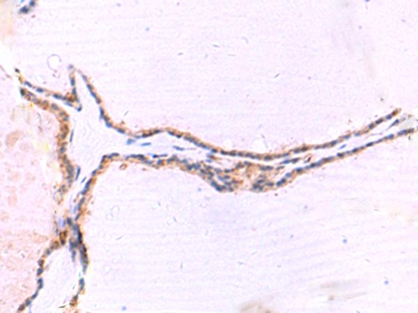 IRGC1 / CINEMA Antibody - Immunohistochemistry of paraffin-embedded Human thyroid cancer tissue  using IRGC Polyclonal Antibody at dilution of 1:30(×200)